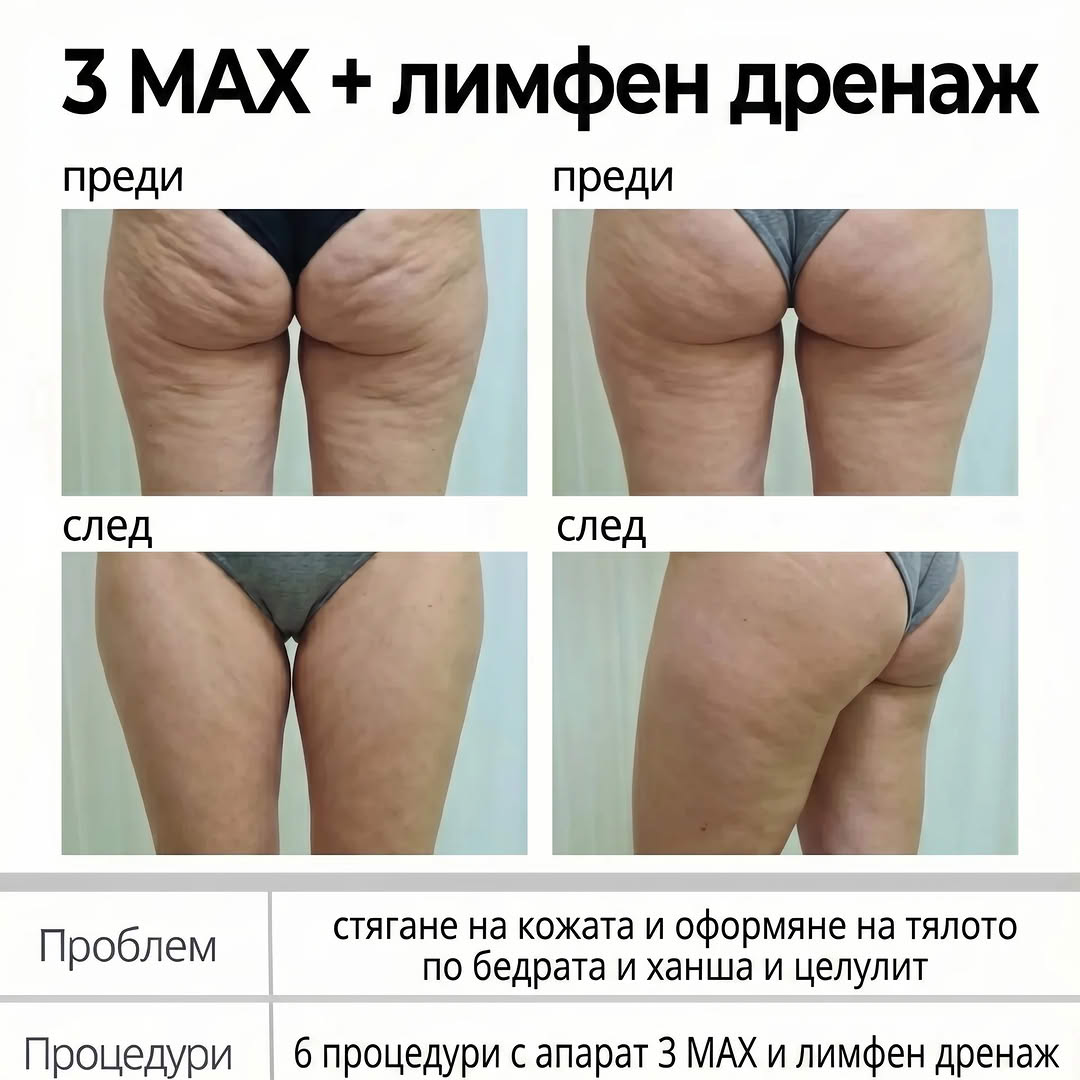 3-MAX® реални резултати преди и след: намаляване на целулита и стягане по бедрата и седалището с 6 процедури и лимфен дренаж
